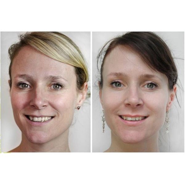 Dermaroller 540 needles with Titanium needles 0.3 mm for the face - | Fashiongirl