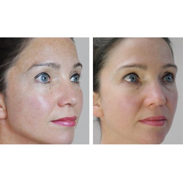 Dermaroller 540 needles with Titanium needles 0.3 mm for the face - | Fashiongirl